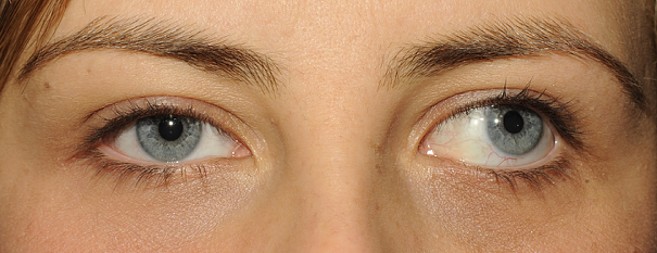 exotropia