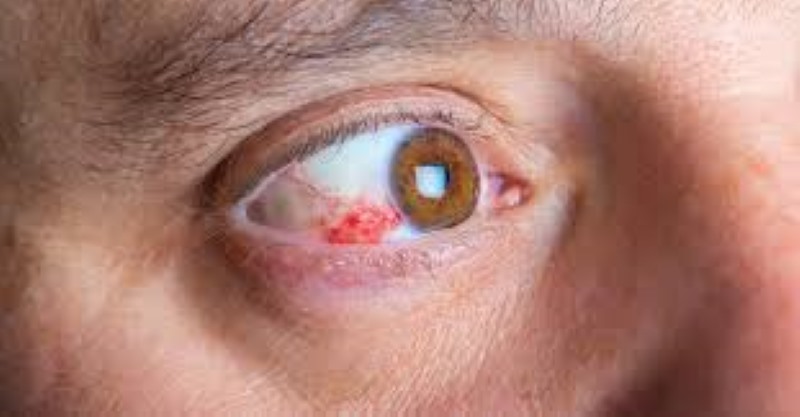 retinopatia diabética diabetes