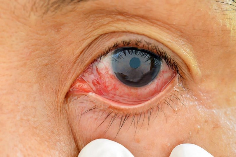 descolamento de retina