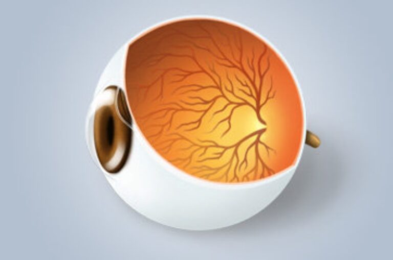 Oclusões Vasculares Retinianas