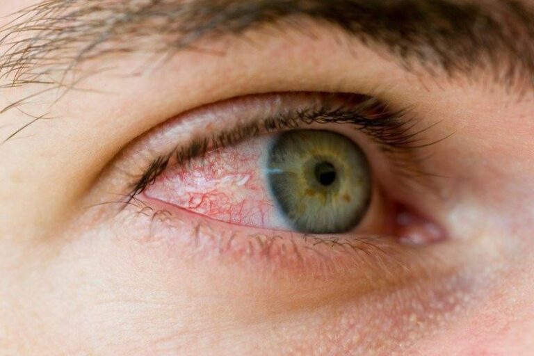 Descolamento-de-retina