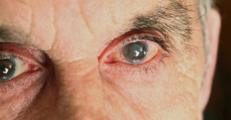 cegueira por toxoplasmose ocular