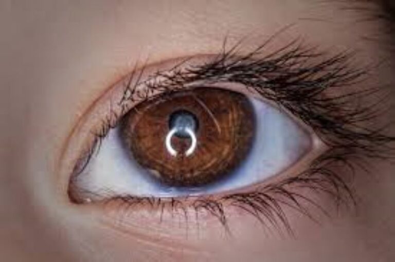 toxoplasmose ocular