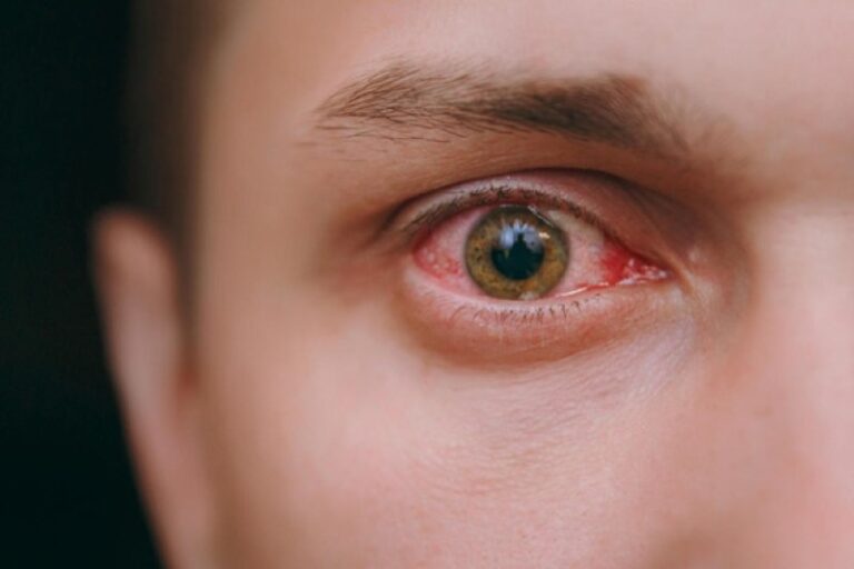 descolamento de retina